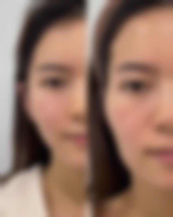 祛痣疤痕修复时间大揭秘！治疗方式如何影响修复时间？