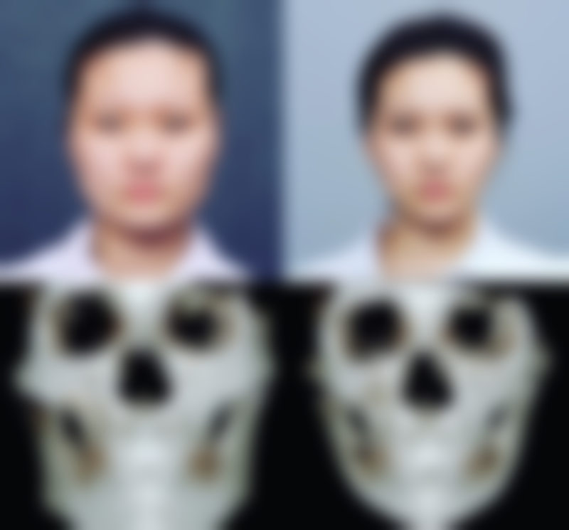 不同假体类型对哺乳的影响