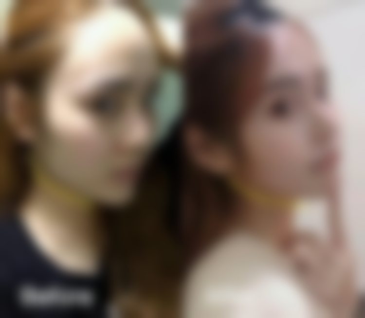 杭州连天美医疗美容医院菲欧曼优塑玻尿酸口周年轻化项目优势