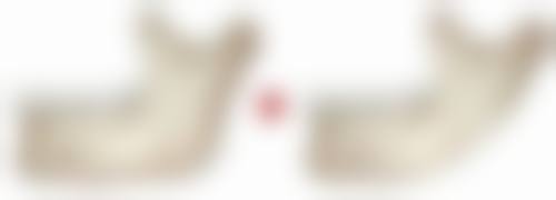 隆胸术后隐患应对与总结