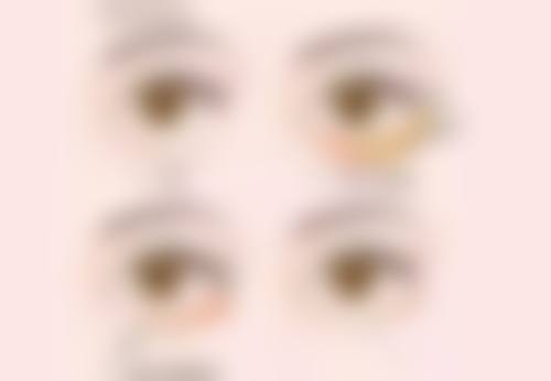 做双眼皮需注意啥？术后饮食禁忌要牢记