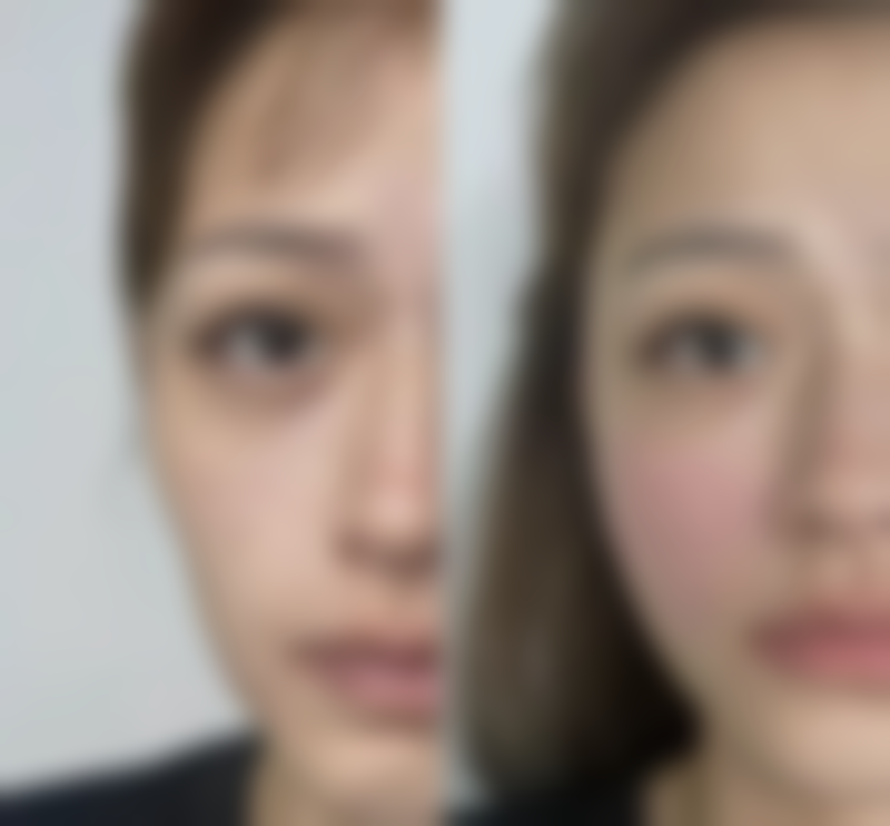 隆胸术后护理不当的风险