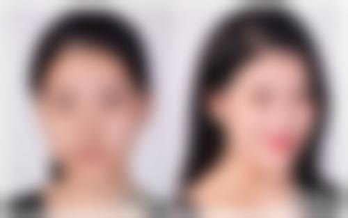 双眼皮术后到底能不能吹风？不同阶段吹风建议揭秘，让恢复更安心！ 