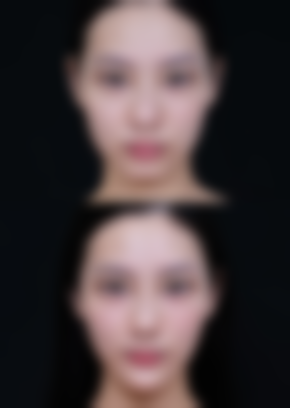 双眼皮后冰敷该多久一次？每日3 - 4次或隔2 - 3小时一次，助减渗出缓解肿胀 