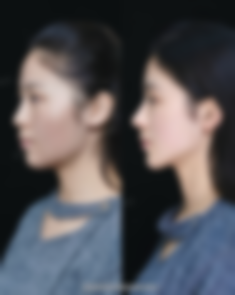 未拆线或刚拆线后几天，吹风需谨慎