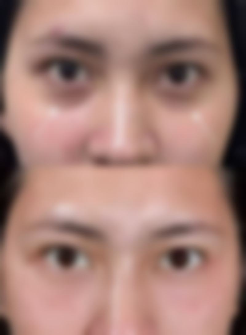 经常拍打眼部下方真能去除眼袋吗？了解其改善轻症、促循环作用及操作方法很重要 