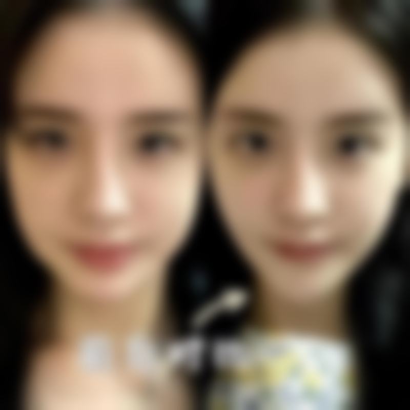 眼袋怎么刮痧按摩有技巧？不同骨干医生方案大揭秘