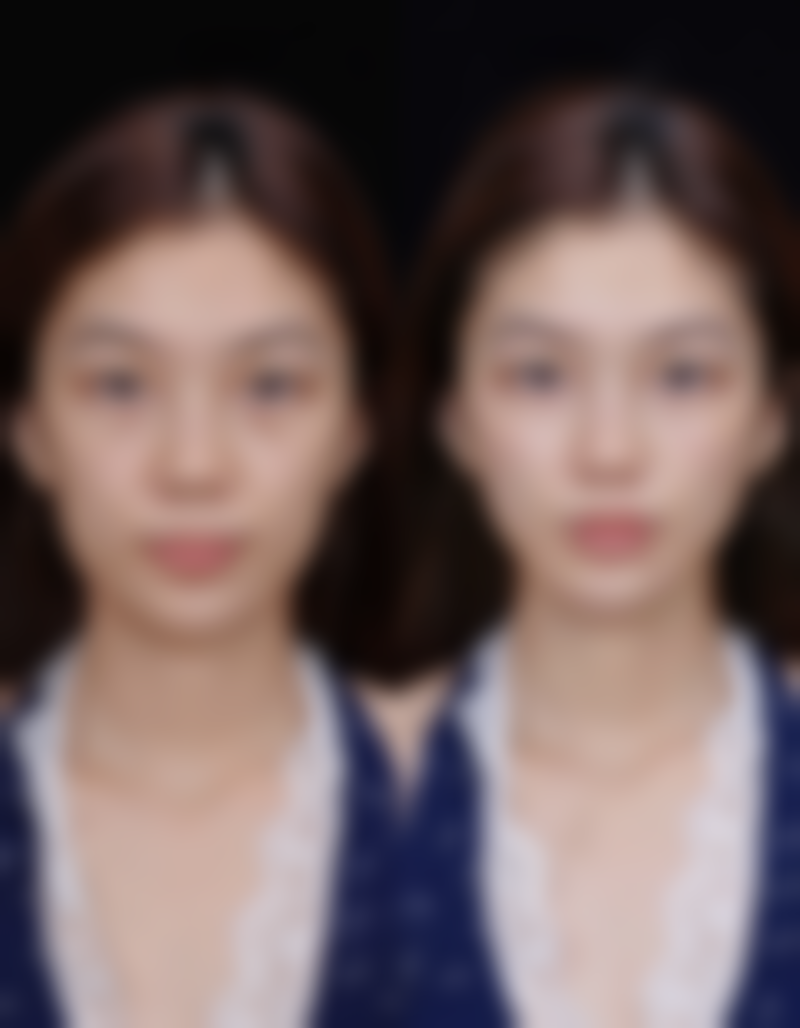 如何快速消除疤痕增生？核心治疗方案之手术治疗