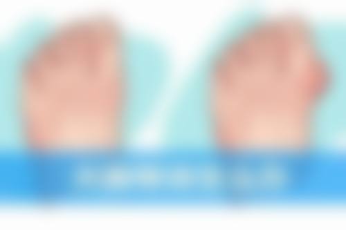 突然双眼皮肿了，就医提示有哪些？