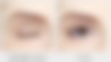 自体隆鼻软骨后遗症知多少?植入物移位及外形不佳问题分析