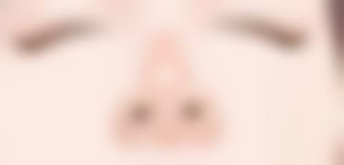 自体隆鼻软骨后遗症知多少?软骨异常问题探讨