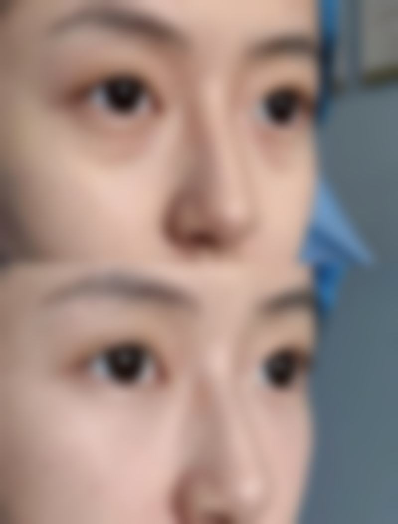 如何紧致肌肤告别熊猫眼？局部护理有妙招