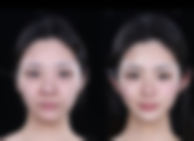 手术留下的疤痕能去掉吗？多种方法可改善外观、减少增生，让疤痕不明显 