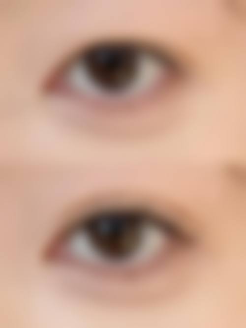 五、北京伽美整形医院实例