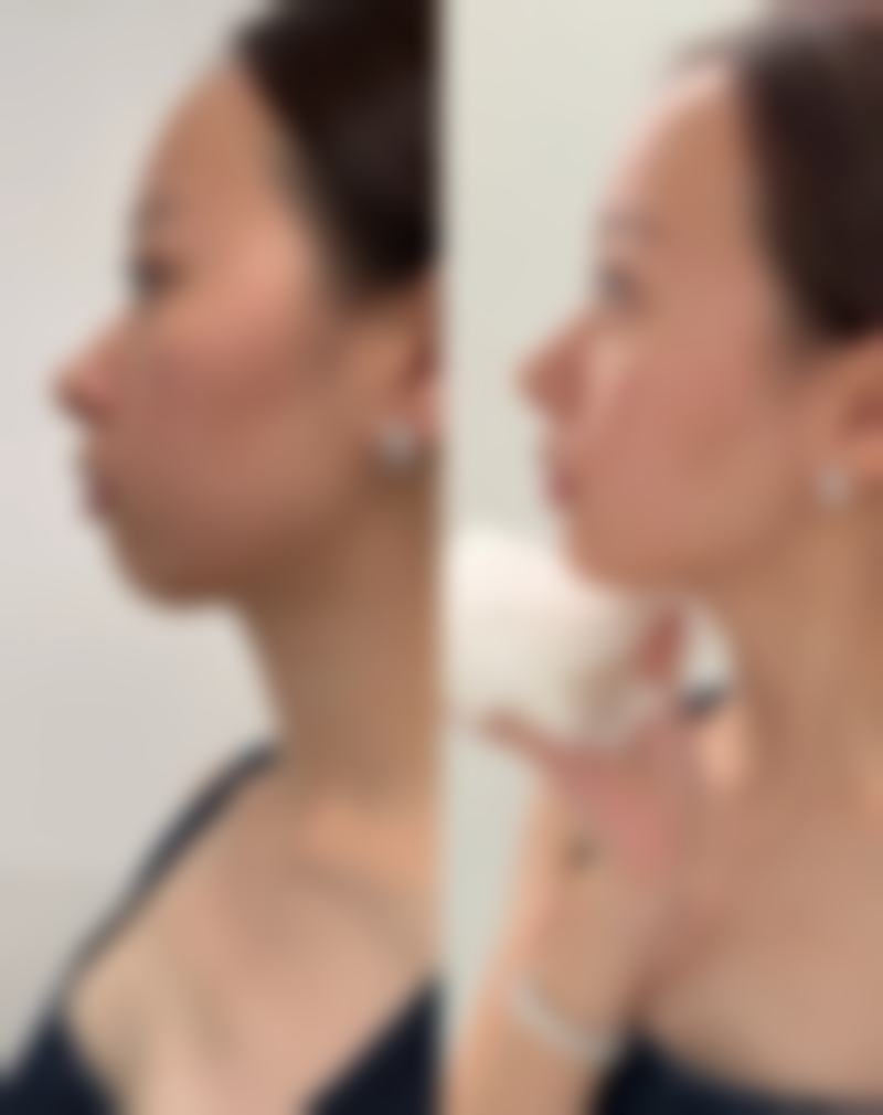 割双眼皮后多久能同房揭秘