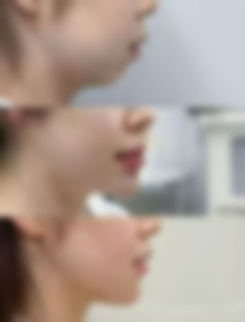 想让单眼皮变双眼皮?手术整形持久又多样