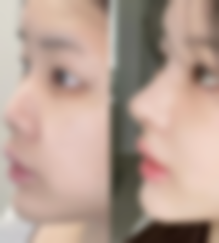 隆鼻多久能消肿？异常情况提示