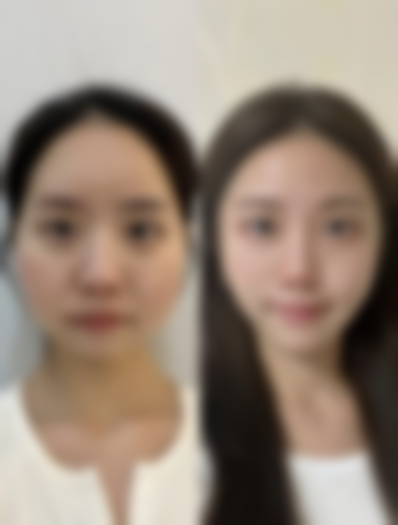 隆鼻多久能消肿？各类术式消肿周期揭秘，护理有方加速恢复美鼻可期 