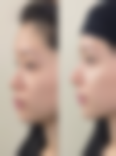 瘦脸针注射周期及成效说明