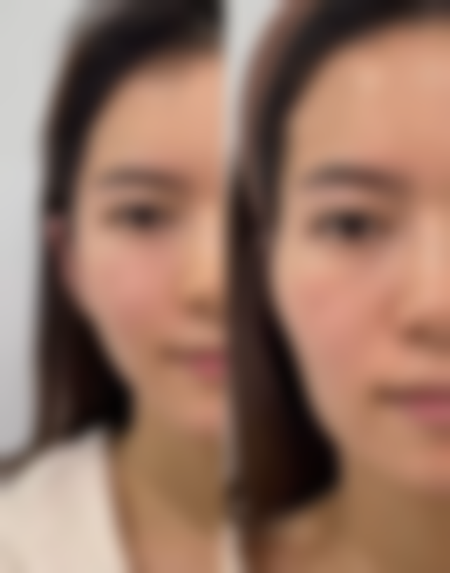 长期下眼袋去除之注意事项与医院推荐