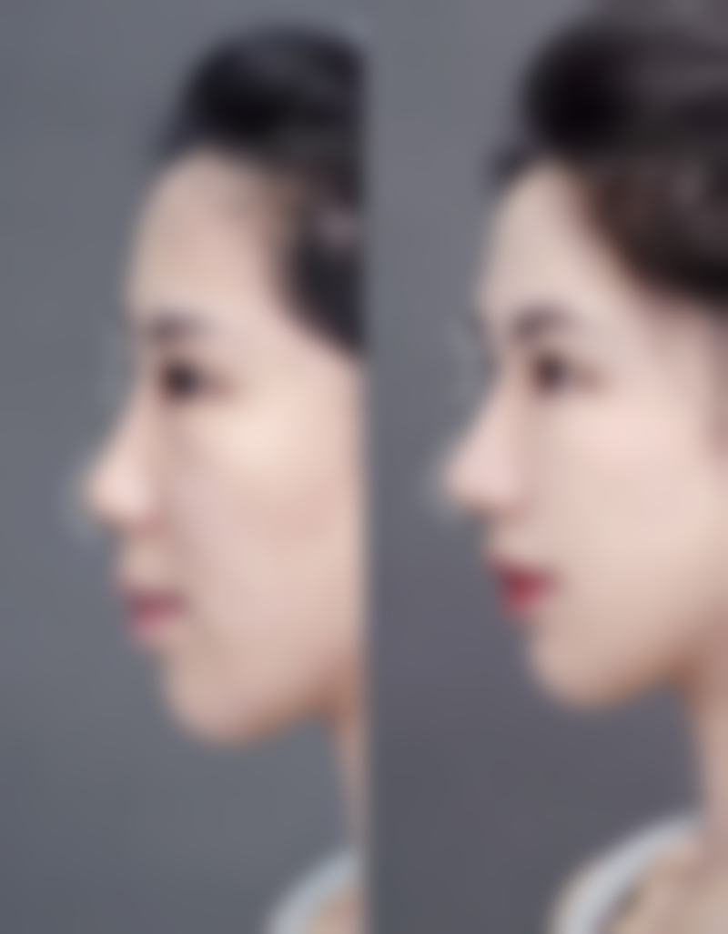 烫伤疤痕去除有妙方，不同情况适配方案