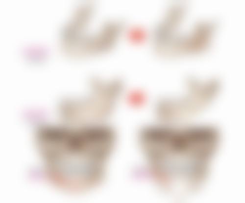 假体隆胸后多久能随心触摸?术后六个月及个体完全修复情况揭秘