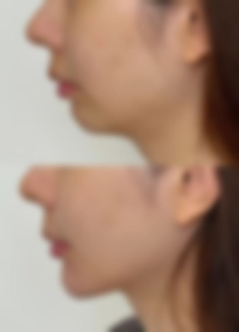 双眼皮拆线后眼角小疙瘩能否修复？处理方式全知道