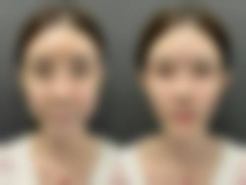 面部摔伤留疤怎么搞？激光治疗有妙招