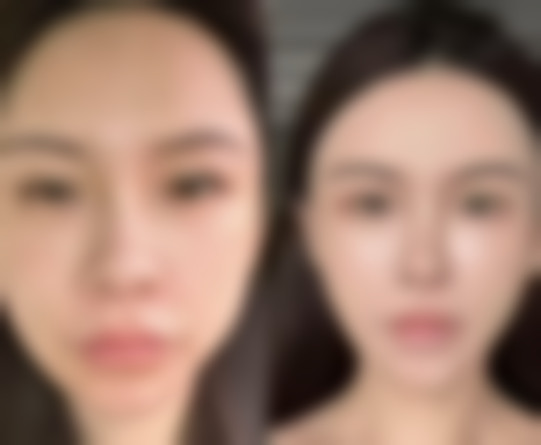 面部摔伤留疤咋解决？其他治疗来助力