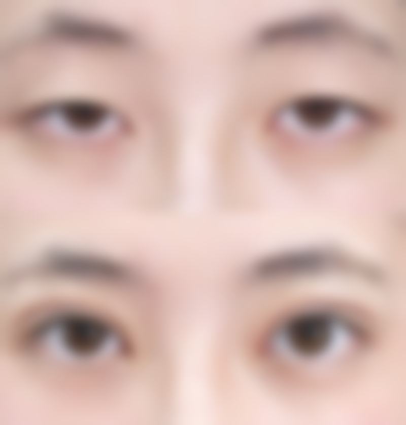 面部摔伤留疤咋处理？注射药物有成效