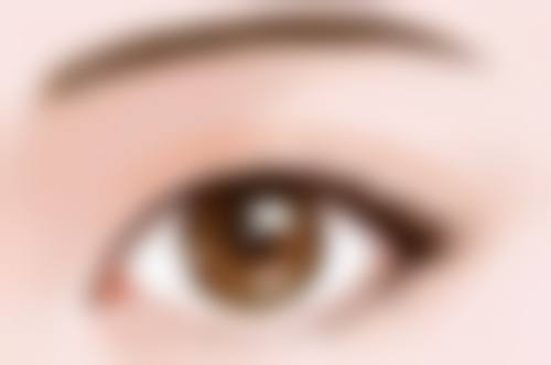 双眼皮术后3个月修复：特殊早期修复时机