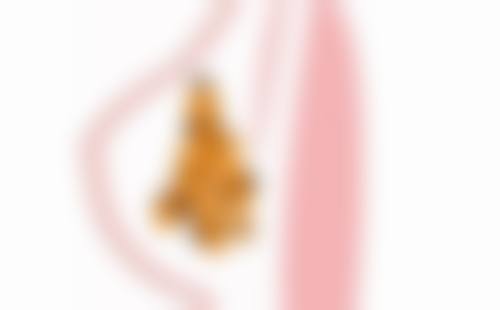 双眼皮术后3个月修复：通用修复前提与注意事项