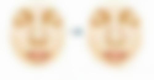 双眼皮术后3个月修复：相关参考实例