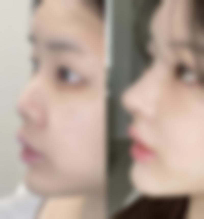 自体脂肪填充眼袋成效能维持多久？脂肪细胞存活率的影响