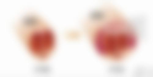 7.5毫米双眼皮的适用人群及术前术后注意事项