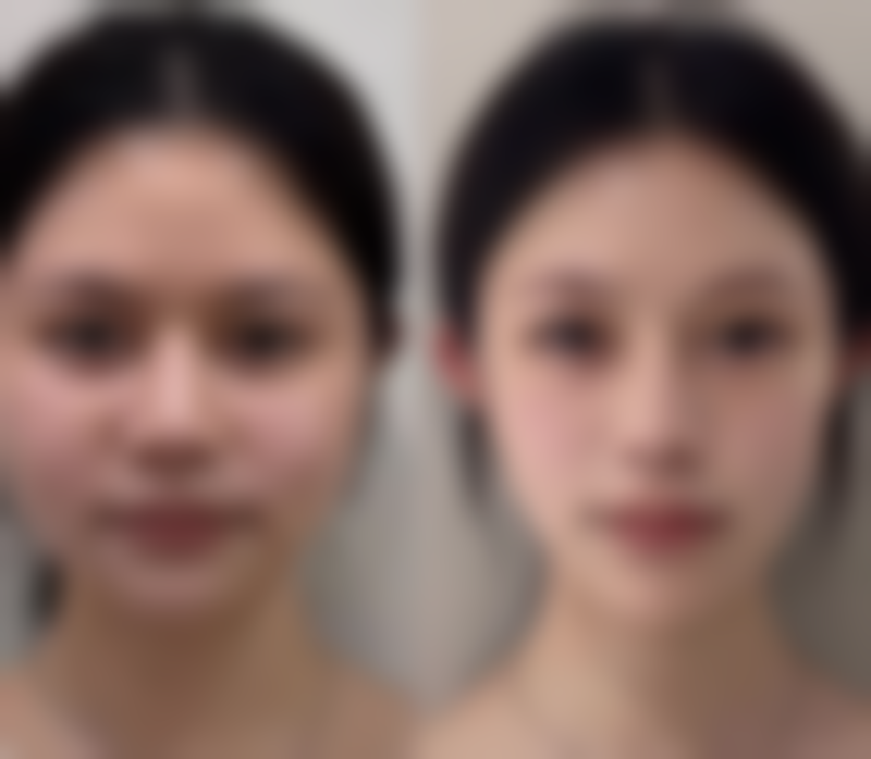 打瘦脸针后怀孕的特殊情况咋处理?谨慎原则保护母婴健康