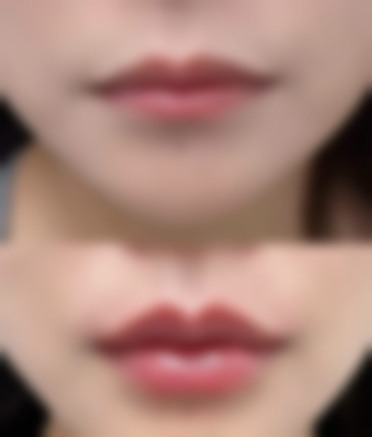 射频紧肤：初期松弛的贴心呵护