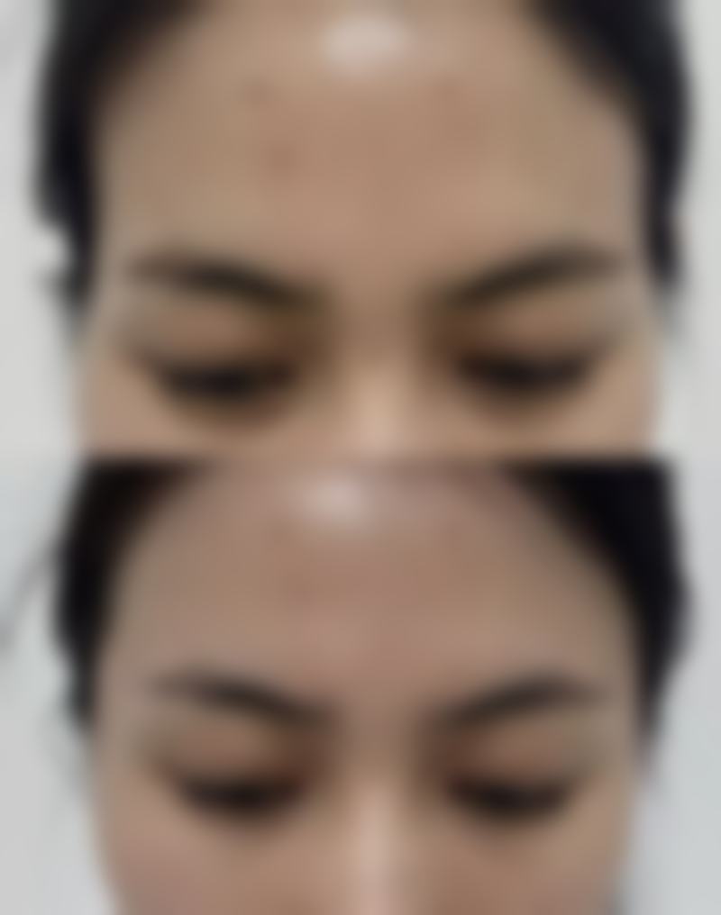 瘦脸针注射危害知多少？常见反应、过敏及操作风险全解析，附规避建议 