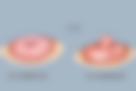 眼袋手术后选啥疤痕膏？使用禁忌与注意事项要牢记