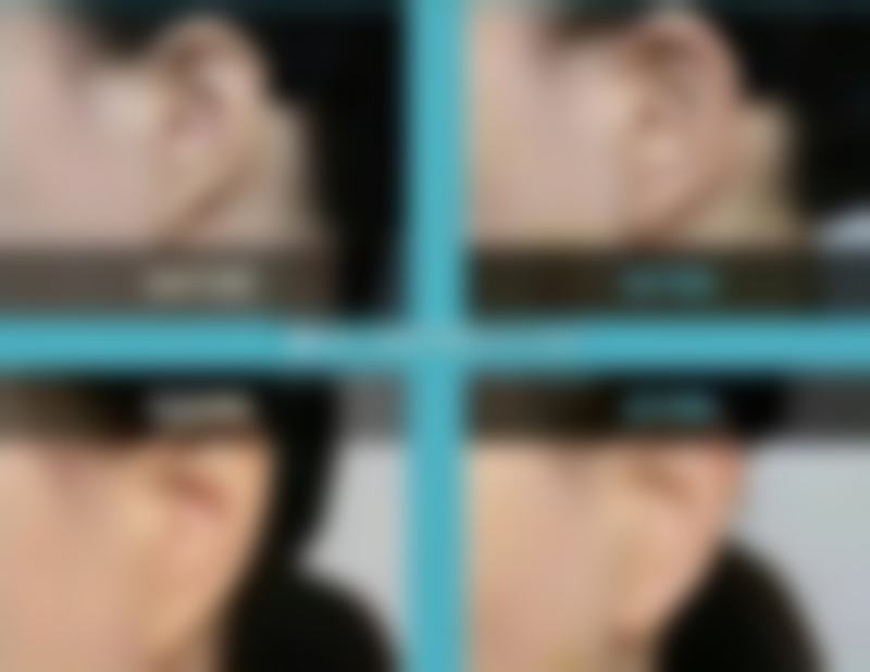 眼袋手术后选啥疤痕膏？硅酮、肝素钠等多类药膏，抑制增生促愈合有妙招 