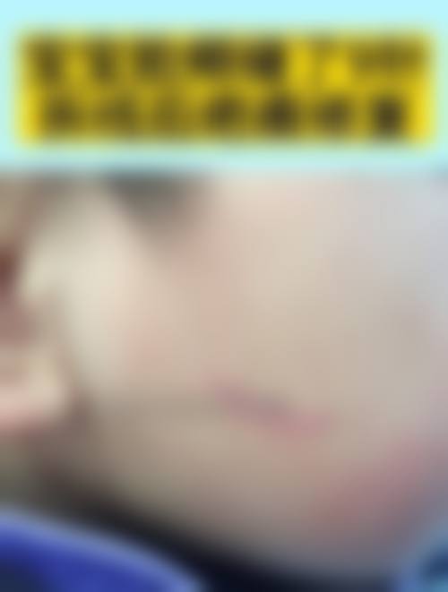 四、厦门174医院烧伤整形科实例