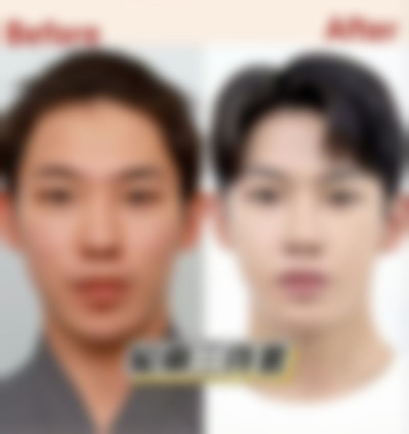 打瘦脸针后脸部僵硬不用愁！多途径护理、治疗方案助你快速恢复自然