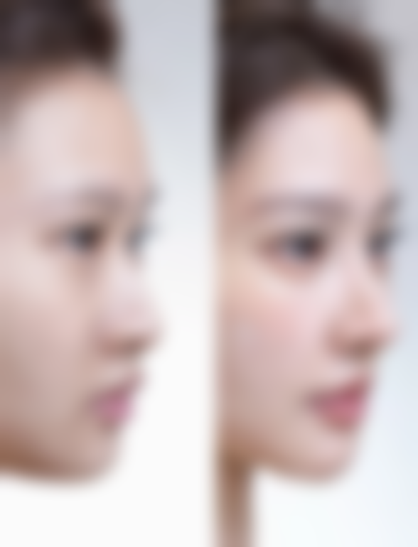 打瘦脸针后脸部僵硬别发愁！专精医疗干预来助力