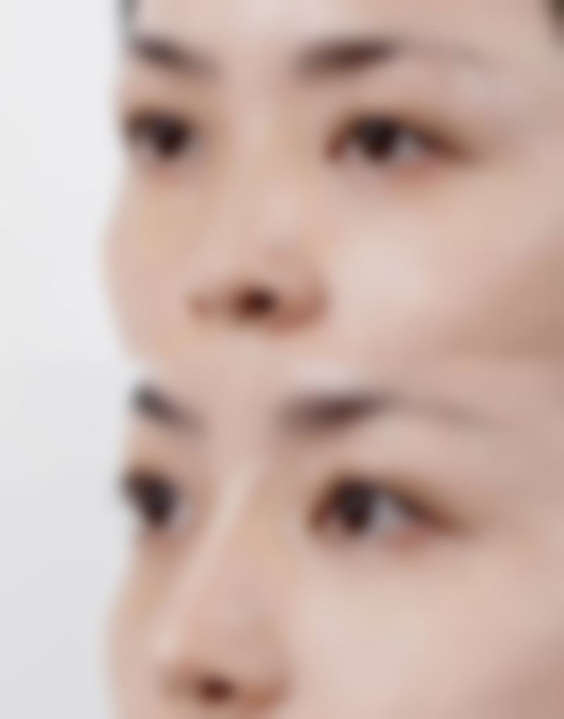 五、成都艺颜佳人整形医院实例