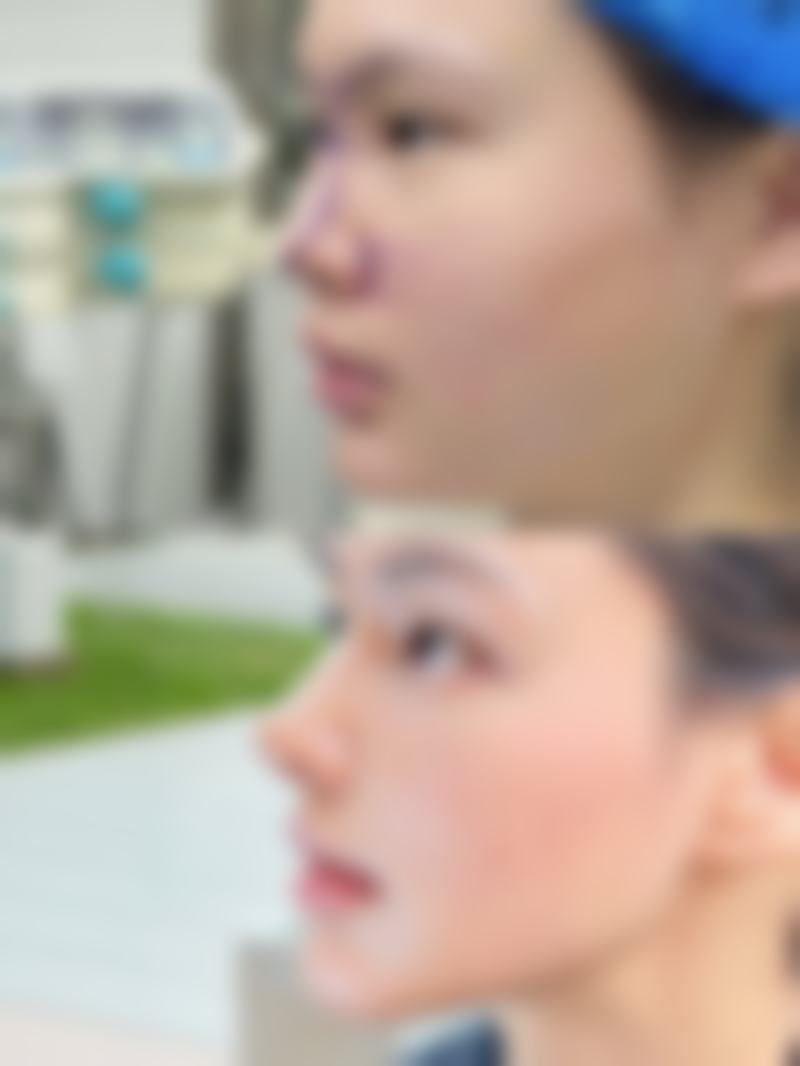 埋线双眼皮窄了修复有啥讲究？时机与护理特别重要