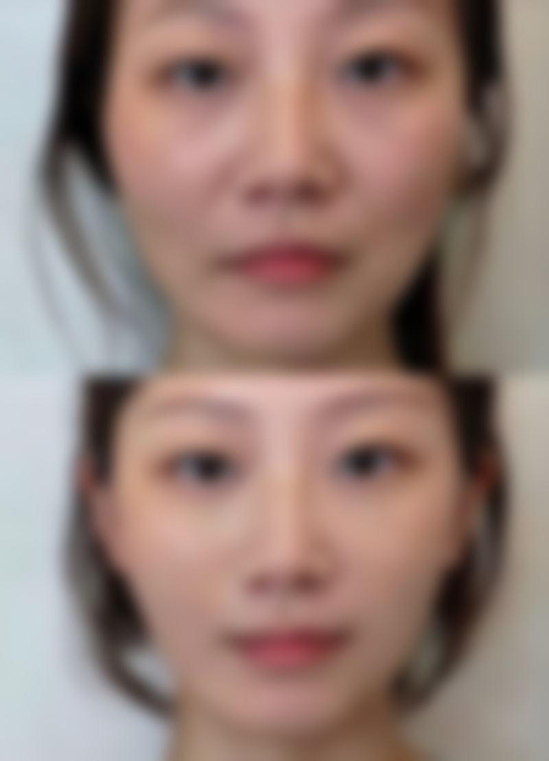 如何科学应对疤痕增生？