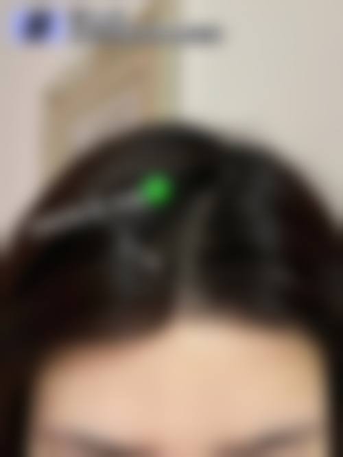 四、南昌碧莲盛植发医院实例