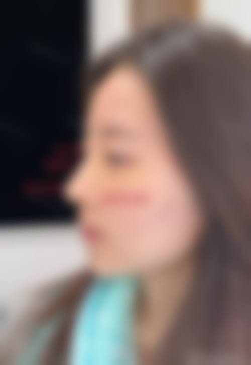 五、石家庄星面孔美兔整形医院实例