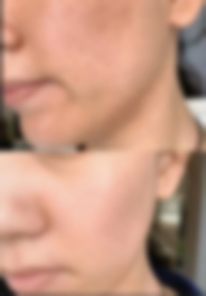 打保妥适瘦脸针成效咋样？关注显现与维持时间