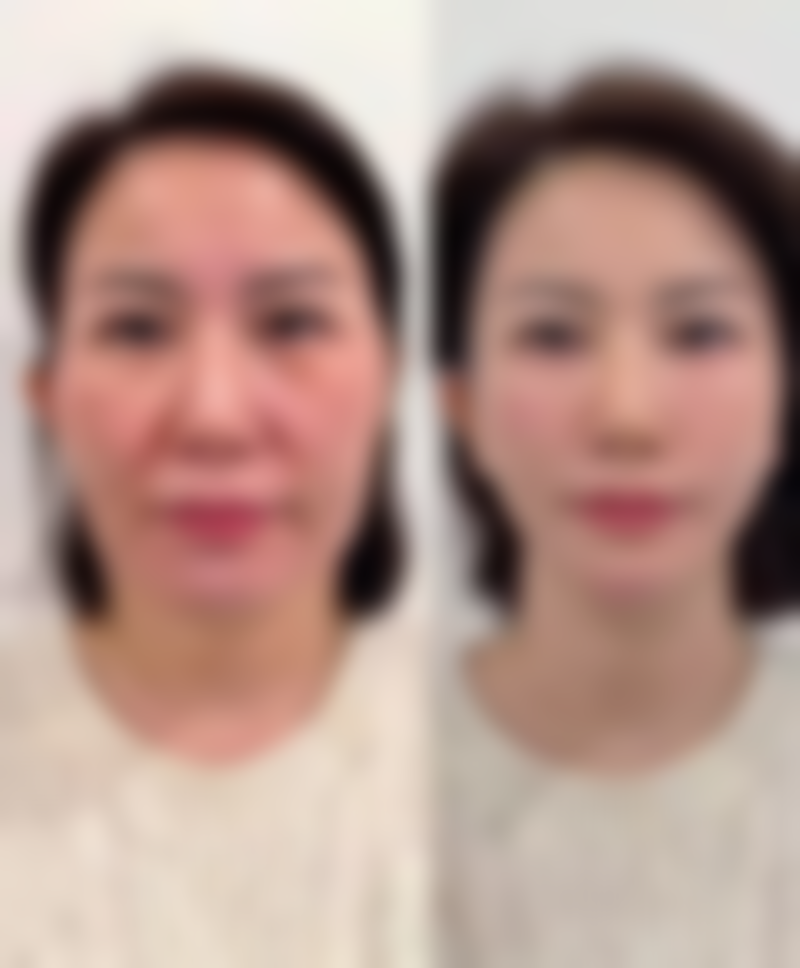 埋线双眼皮以后能取线吗？取线后修复情况